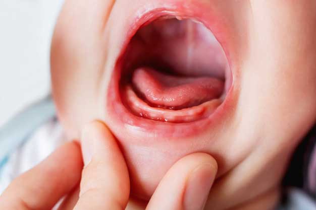 Bebeklerde ağız yarası nedenleri 